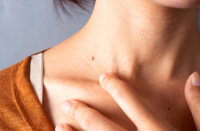 Skin cancer is the fourth most common cancer in the UAE: What you need to know