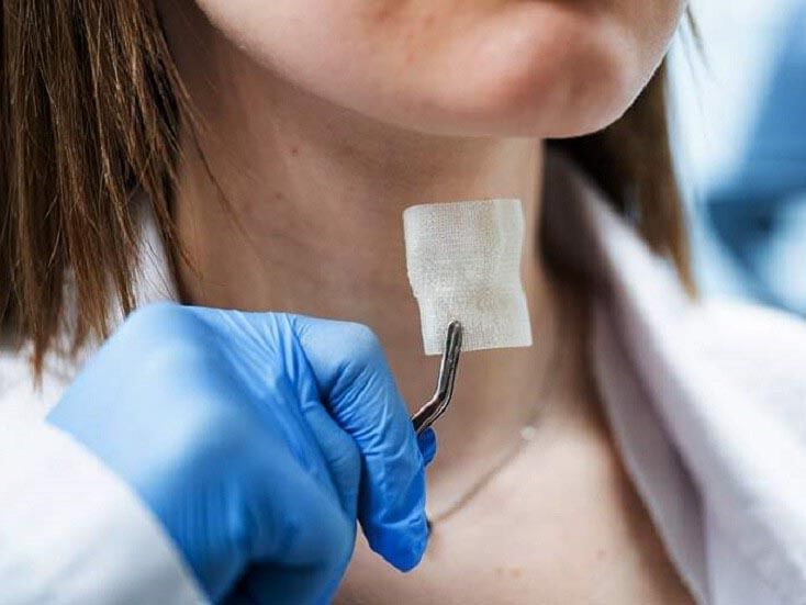 Russian scientists develop first 3D-printed laryngeal implant to accelerate cancer recovery
